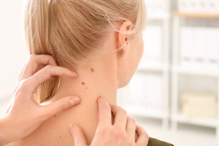 Mujer con un posible melanoma