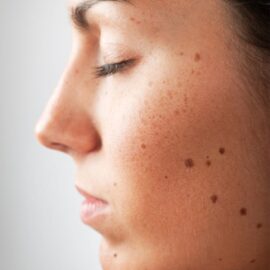 Cómo diferenciar un melanoma de un lunar común: 5 señales para detectarlo