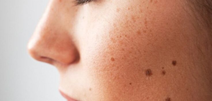 Cómo diferenciar un melanoma de un lunar común: 5 señales para detectarlo