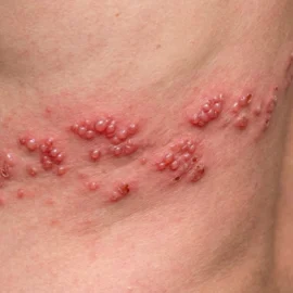 Herpes zóster: por qué sale, si se contagia y quién se vacuna en Castilla y León