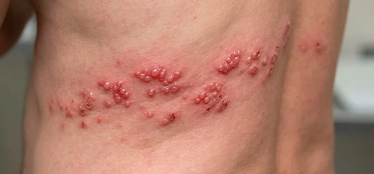 Herpes zóster: por qué sale, si se contagia y quién se vacuna en Castilla y León